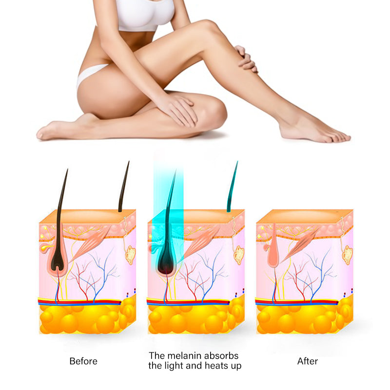 IPL Ice Cooling Laser Hair Removal Device – Painless Home Use 590nm