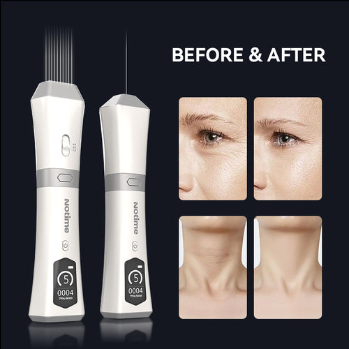 Notime Ultrasonic Anti-Aging Face Lift Device – Wrinkle Reduction & Skin Tightening
